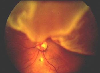 Retina Dekolmanı (ağtabaka Ayrılması)