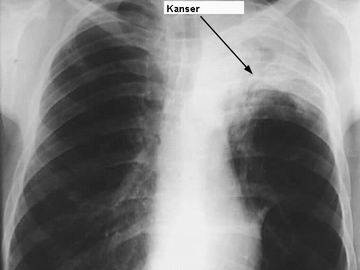 Akciğer Kanseri - Genel Bilgiler