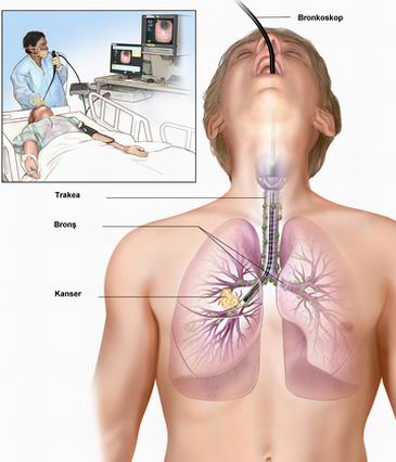Akciğer Kanseri - Tetkik Yöntemleri