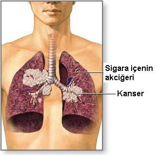 Akciğer Kanseri - Yayılımı Ve Komplikasyonları
